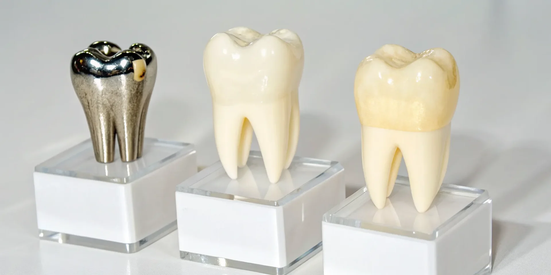 Tooth models comparing a dental cap vs. a crown vs. a veneer.