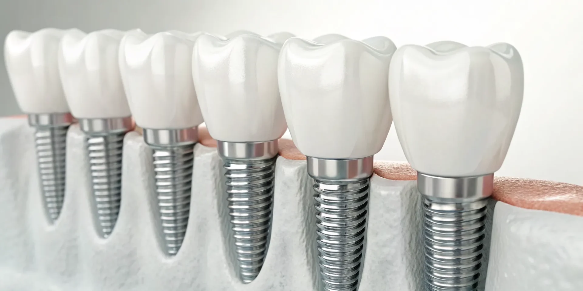 Final crown placement completing a dental implant procedure.
