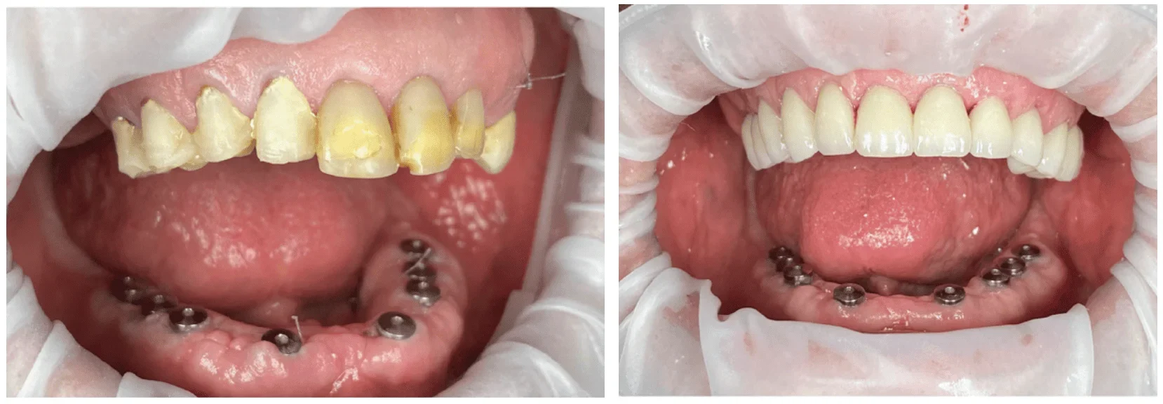 Intraoral photos of the upper and lower teeth before and after treatment
