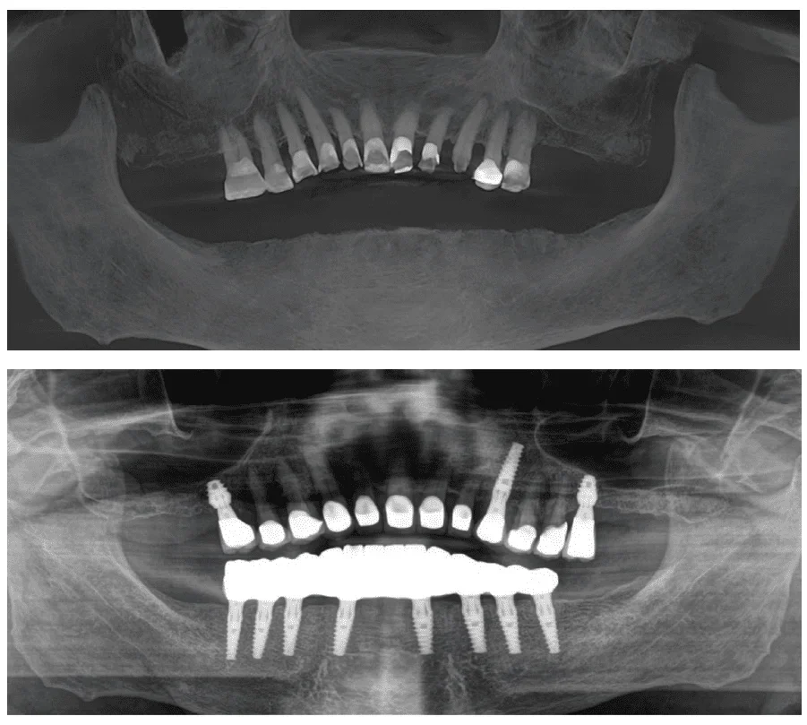 Panoramic X-rays before and after full-arch implant treatment, showing eight lower implants and three upper implants