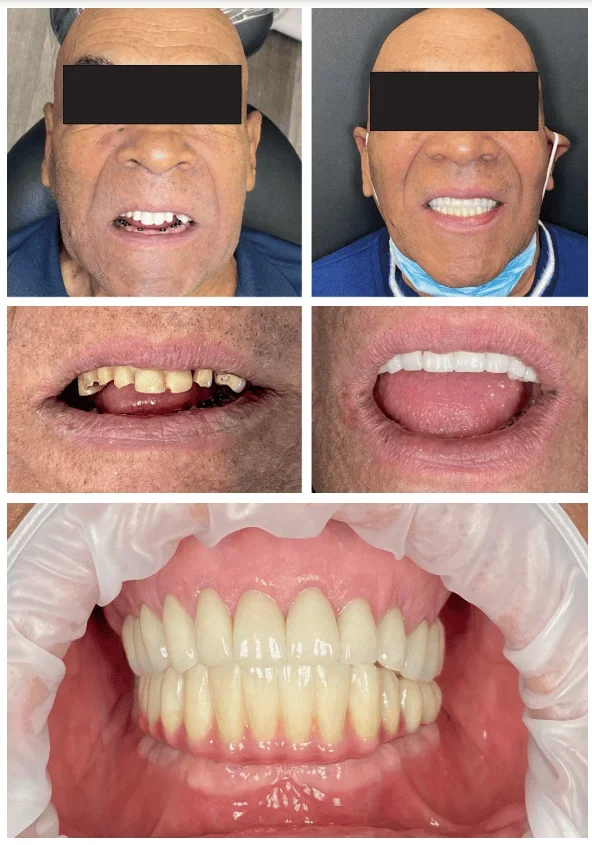 Patient smile before and after full-mouth rehabilitation with dental implants and crowns
