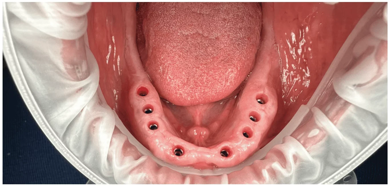 Lower arch dental implants before the final bridge was placed, showing healthy gum tissue